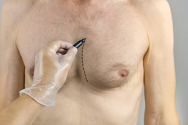 A surgeon marking a patient's chest before a gynecomastia procedure