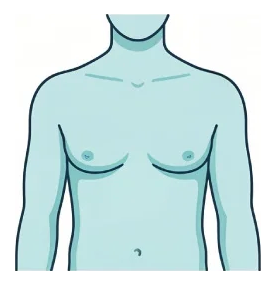 Grade 2 gynecomastia: moderate enlargement across the chest