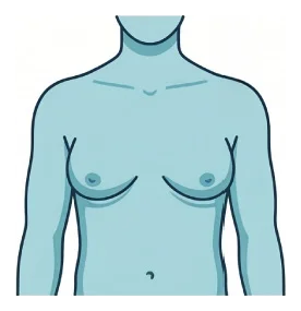 Grade 3 gynecomastia: marked enlargement with skin excess