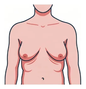 Grade 4 gynecomastia: severe enlargement with significant skin excess